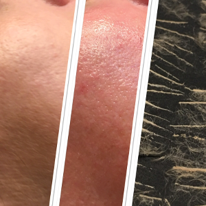 Southport Dermaplaning